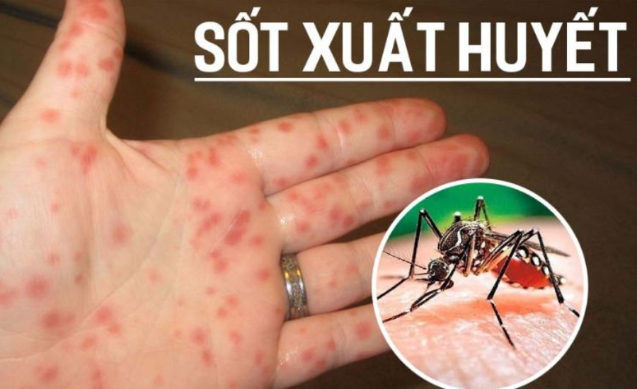 sau khi bị muỗi đốt bao lâu thì bị sốt xuất huyết, xịt chống muỗi, xịt chống muỗi thiên nhiên heroh