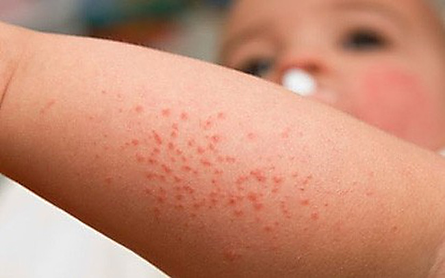 Sau khi bị muỗi đốt bao lâu thì bị sốt xuất huyết?