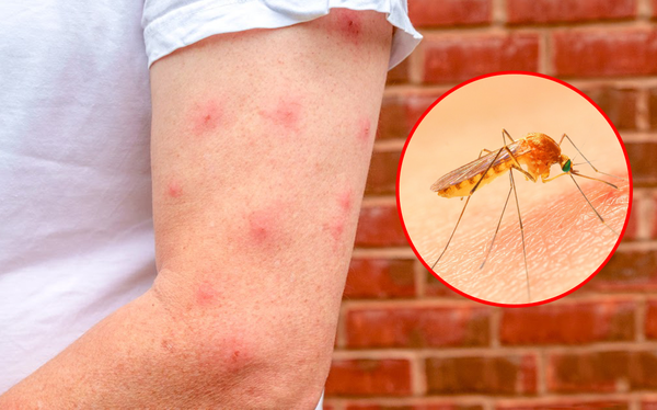 Vết muỗi đốt sẽ hết trong bao lâu? Cách giảm ngứa tức thì