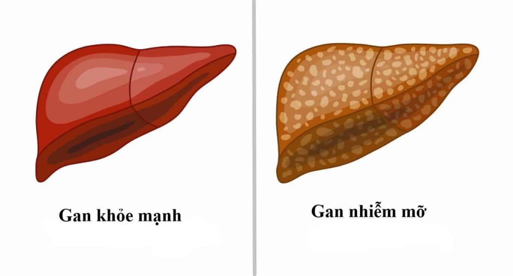 bổ gan giải rượu, cách giải rượu, thức uống giải rượu, giải rượu, nước uống giải rượu, thức uống giải rượu Acol Detox