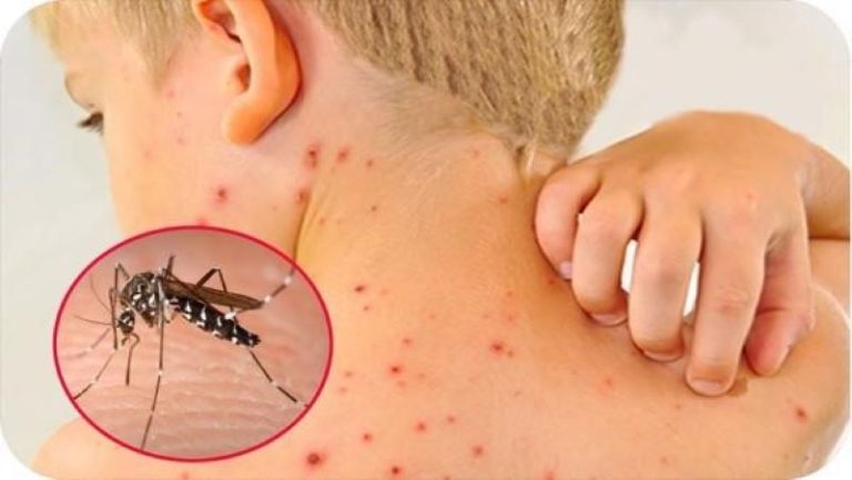 5 cách chống muỗi phòng sốt xuất huyết bạn phải biết!