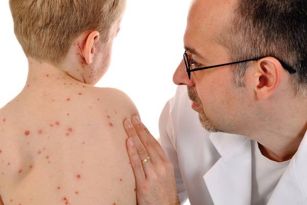 sốt xuất huyết có bị lại không, cách đuổi muỗi tự nhiên, cách đuổi muỗi, xịt chống muỗi thiên nhiên, xịt chống muỗi, xịt muỗi thiên nhiên, xịt chống muỗi thiên nhiên heroh