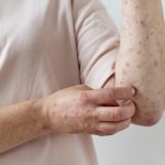 sốt xuất huyết ở người tiểu đường