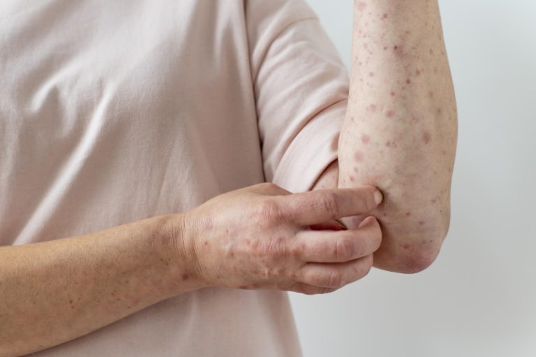 Dấu hiệu sốt xuất huyết ở người tiểu đường và cách phòng ngừa