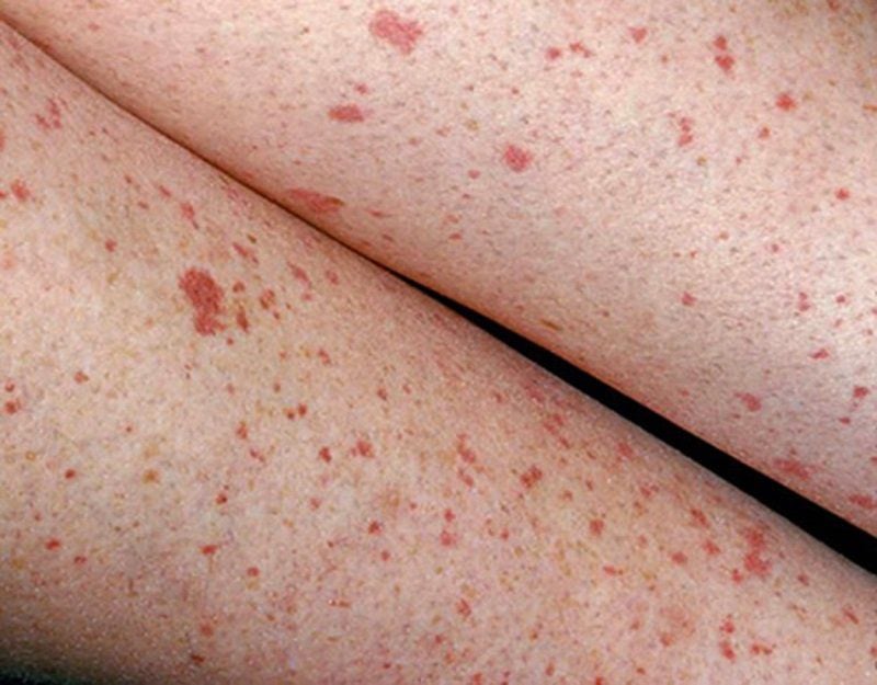 sốt xuất huyết máu đông