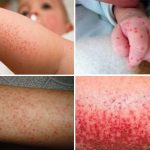 sốt xuất huyết