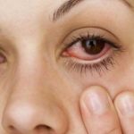 bị thuốc xịt muỗi dính vào mắt, xịt chống muỗi thiên nhiên heroh