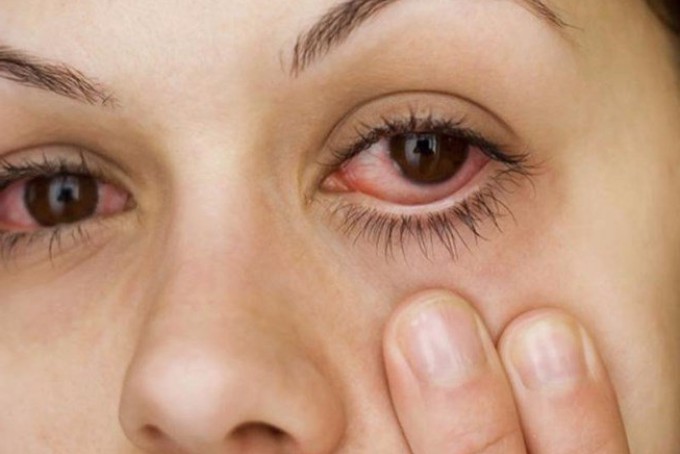 bị thuốc xịt muỗi dính vào mắt, xịt chống muỗi thiên nhiên heroh