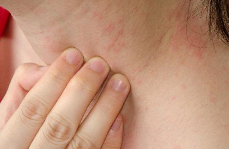 bị thuốc xịt muỗi dính vào mắt, xịt chống muỗi thiên nhiên heroh