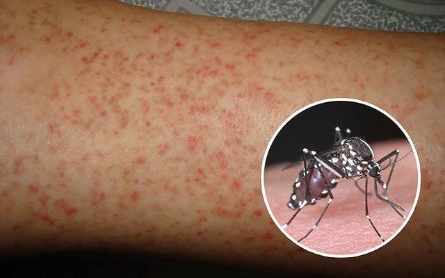 Người tiểu đường bị sốt xuất huyết có nguy hiểm không? xịt chống muỗi thiên nhiên heroh